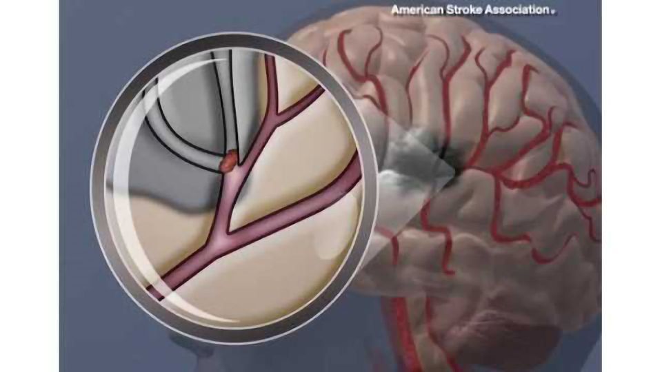 Slowing brain functions linked to increased risk of stroke, death content piece image
