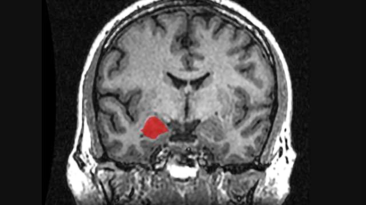 Maturing brain flips function of amygdala in regulating stress hormones