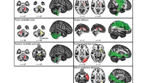 Wii Balance Board induces changes in the brains of MS patients