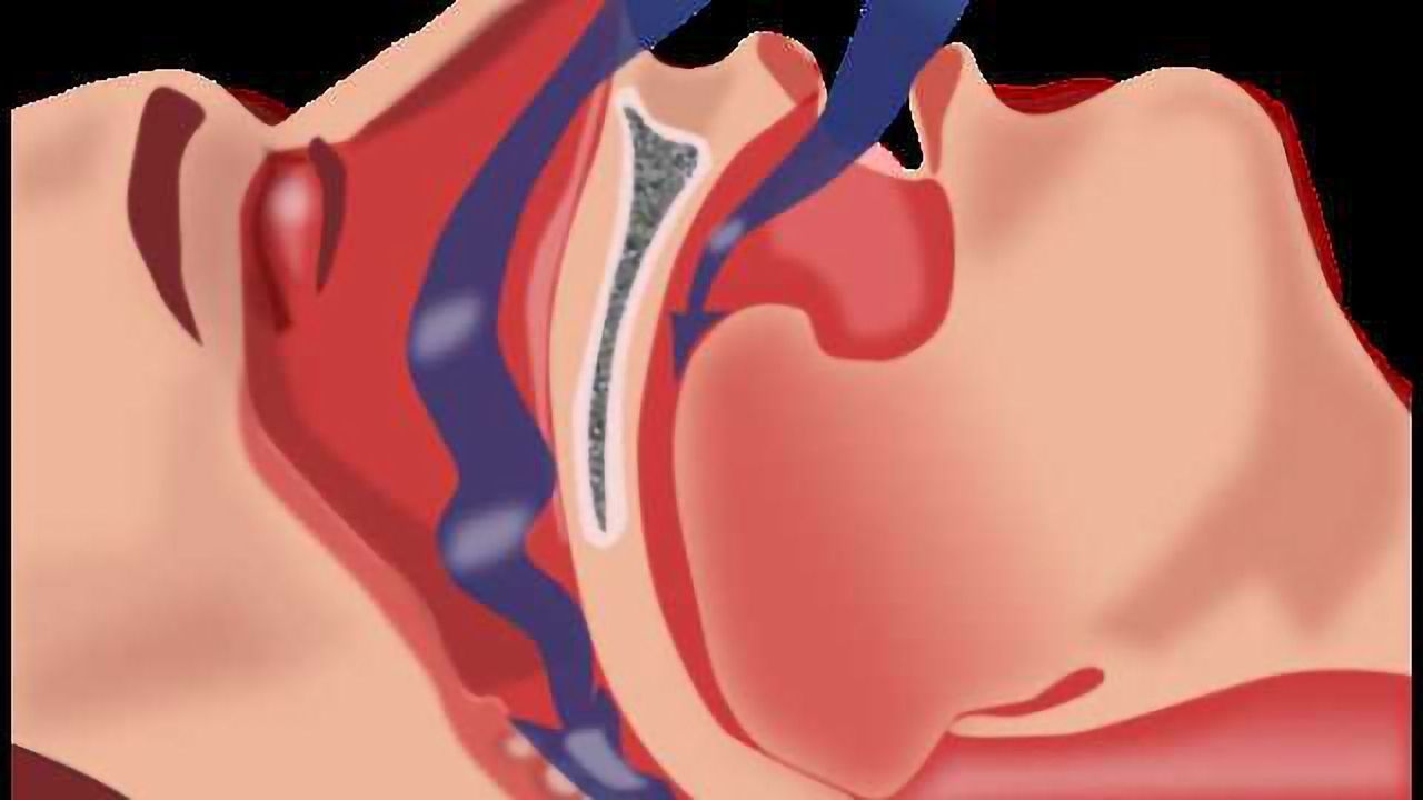 Brain damage caused by severe sleep apnea is reversible