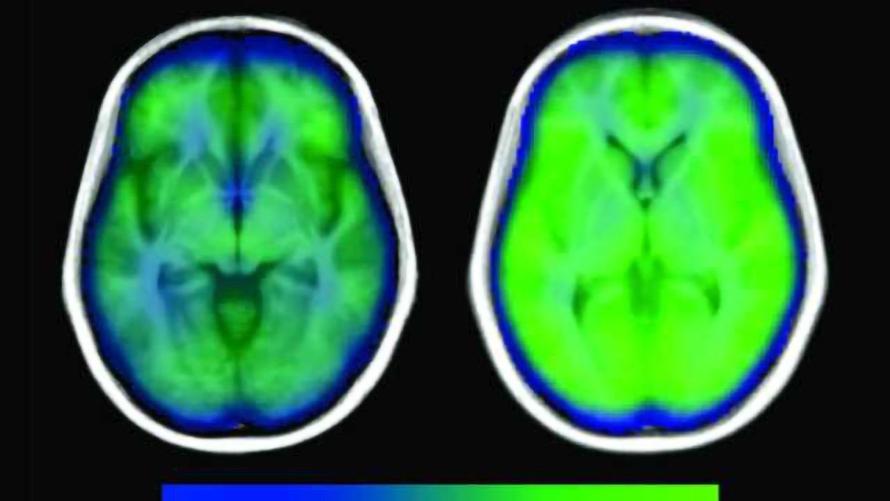 Study provides more evidence that sleep apnea is hurting the brain