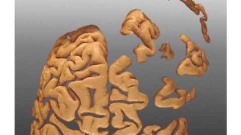 Mining big data yields Alzheimer’s discovery