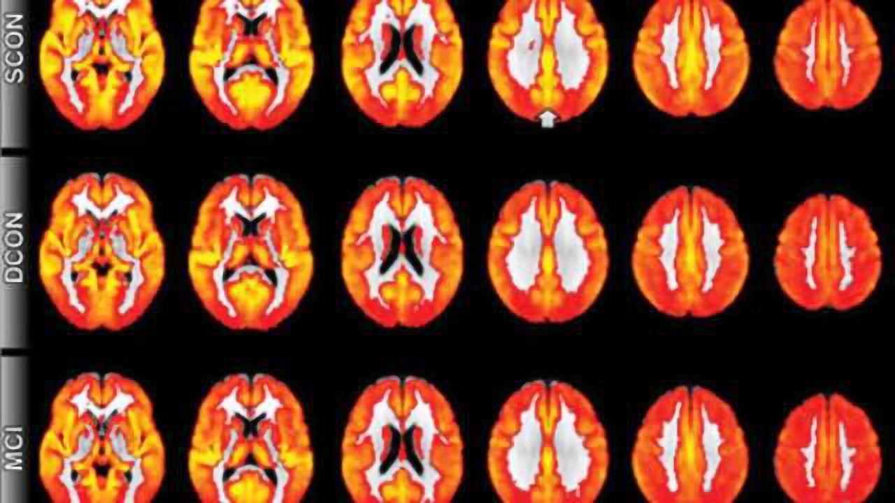 MRI technique detects evidence of cognitive decline before symptoms appear