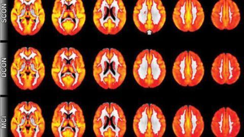 MRI technique detects evidence of cognitive decline before symptoms appear