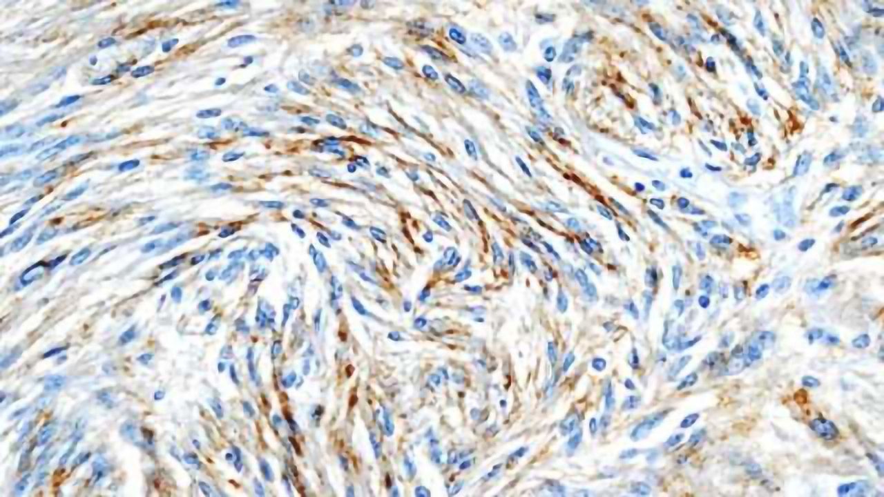 Radiation a risk factor for intracranial meningiomas in young people, study finds