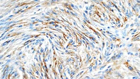 Radiation a risk factor for intracranial meningiomas in young people, study finds