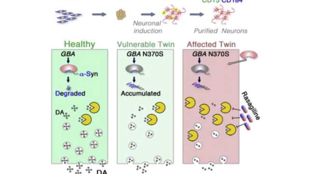 Scientists create Parkinson's disease in a dish