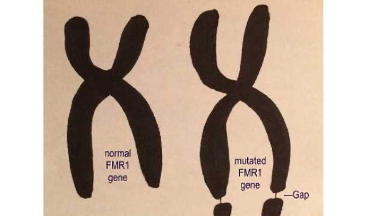 Fragile X study offers hope of new autism treatment