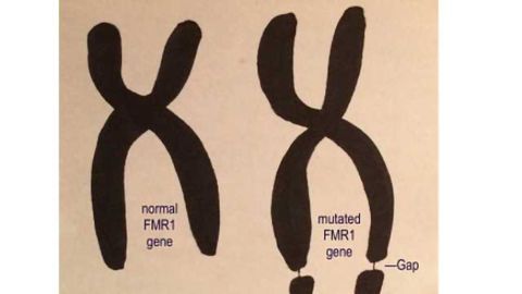 Fragile X study offers hope of new autism treatment