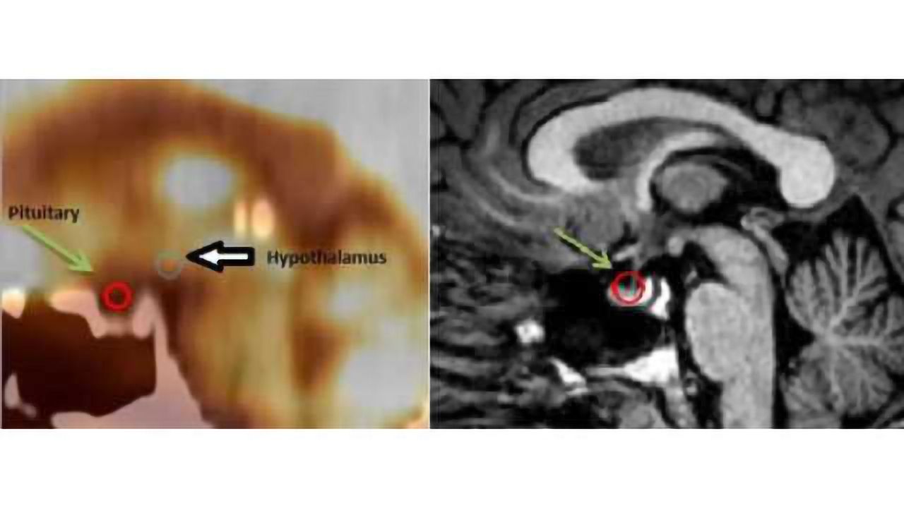 PET/CT shows pituitary abnormalities in veterans with PTSD