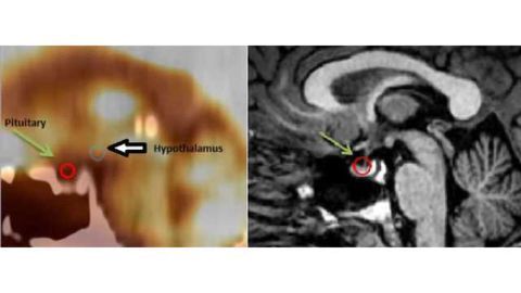 PET/CT shows pituitary abnormalities in veterans with PTSD