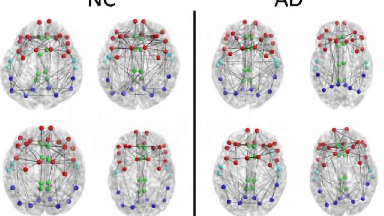Imaging shows brain connection breakdown in early Alzheimer's disease