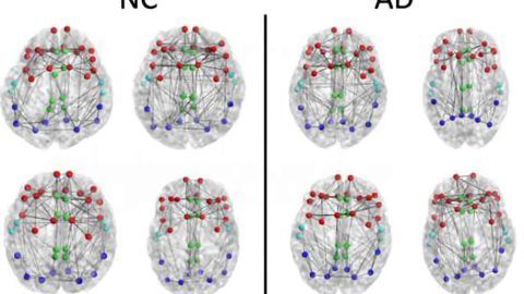 Imaging shows brain connection breakdown in early Alzheimer's disease