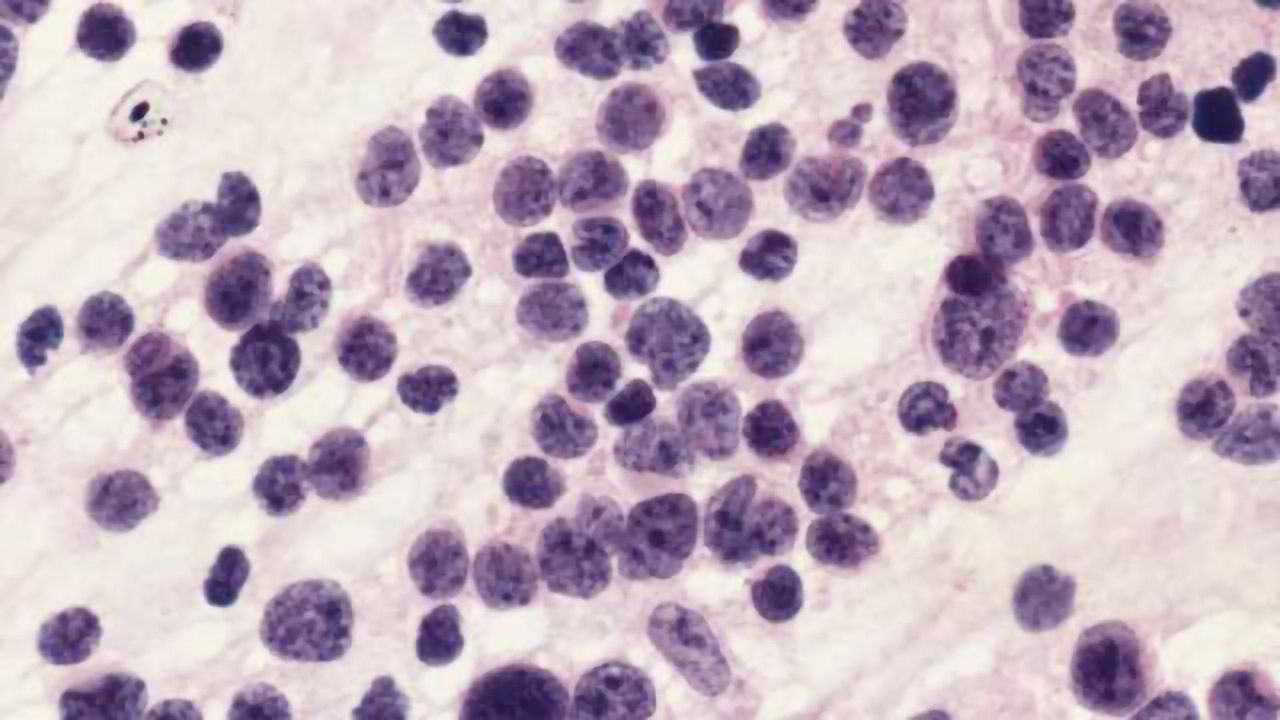 New cause of child brain tumor condition identified