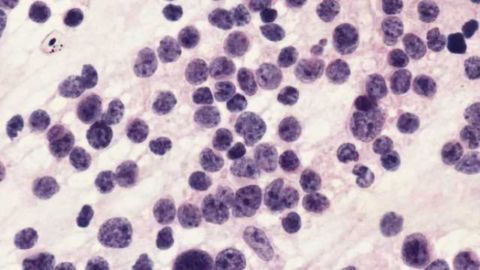 New cause of child brain tumor condition identified