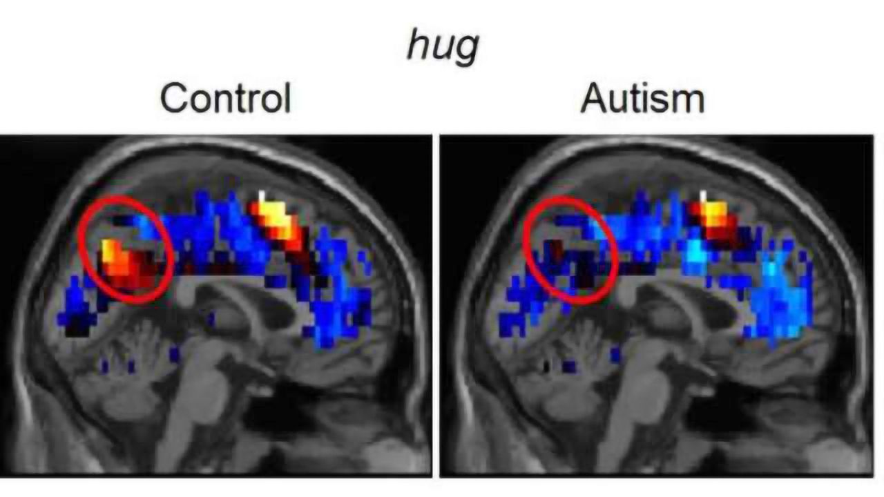 Brain representations of social thoughts accurately predict autism diagnosis