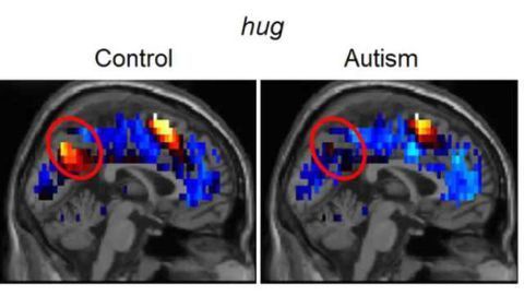 Brain representations of social thoughts accurately predict autism diagnosis