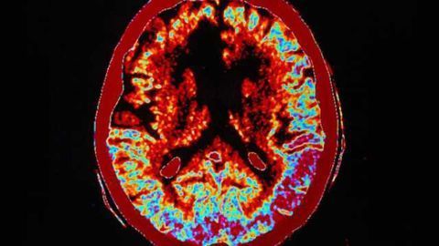 Images of brain after mild stroke predict future risk
