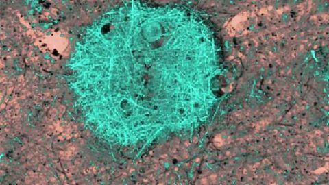 New approach to AD: Psoriasis medication may be effective in the treatment of Alzheimer's
