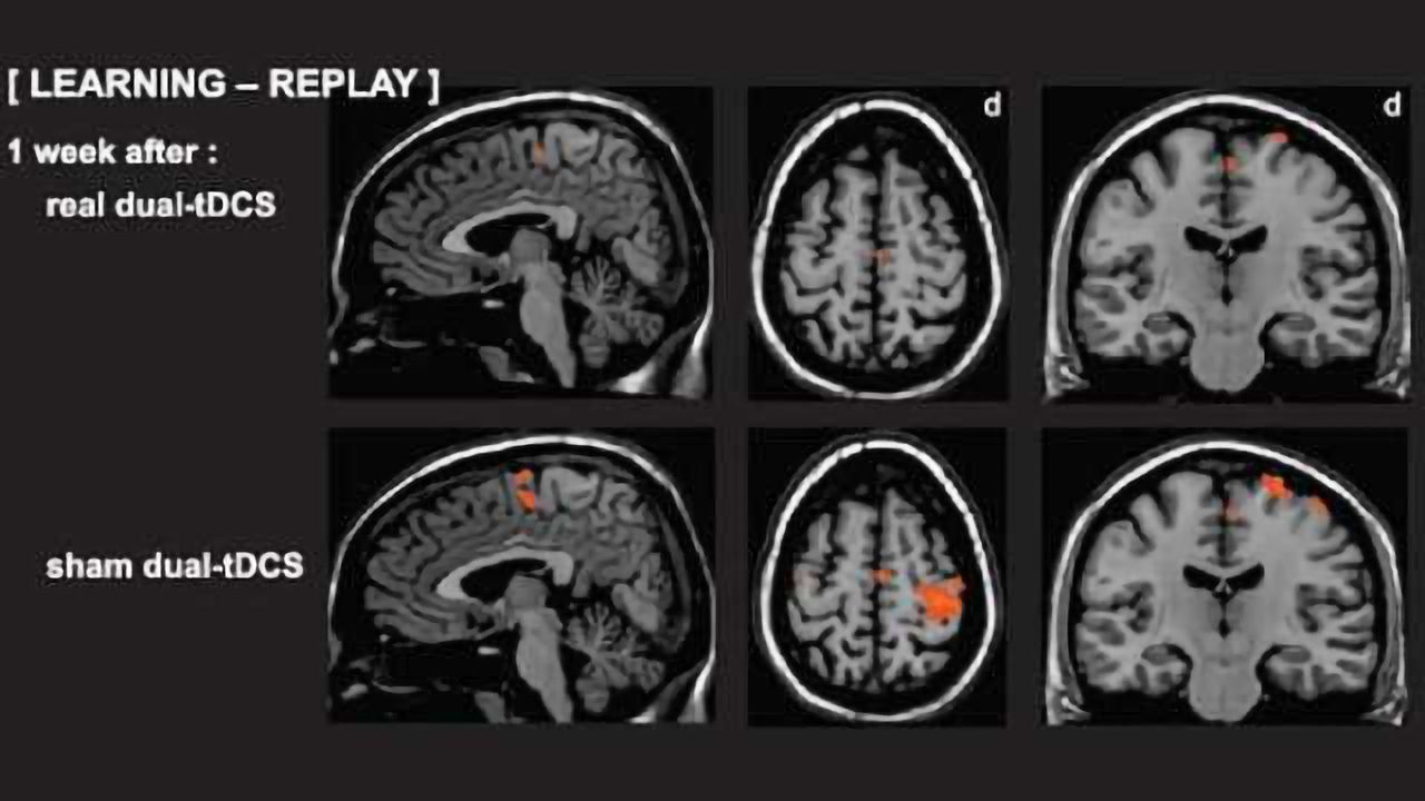 Stroke study shows promising results: Neuro-rehabilitation assists patients with motor skill loss