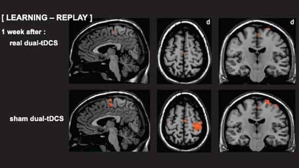 Stroke study shows promising results: Neuro-rehabilitation assists patients with motor skill loss content piece image