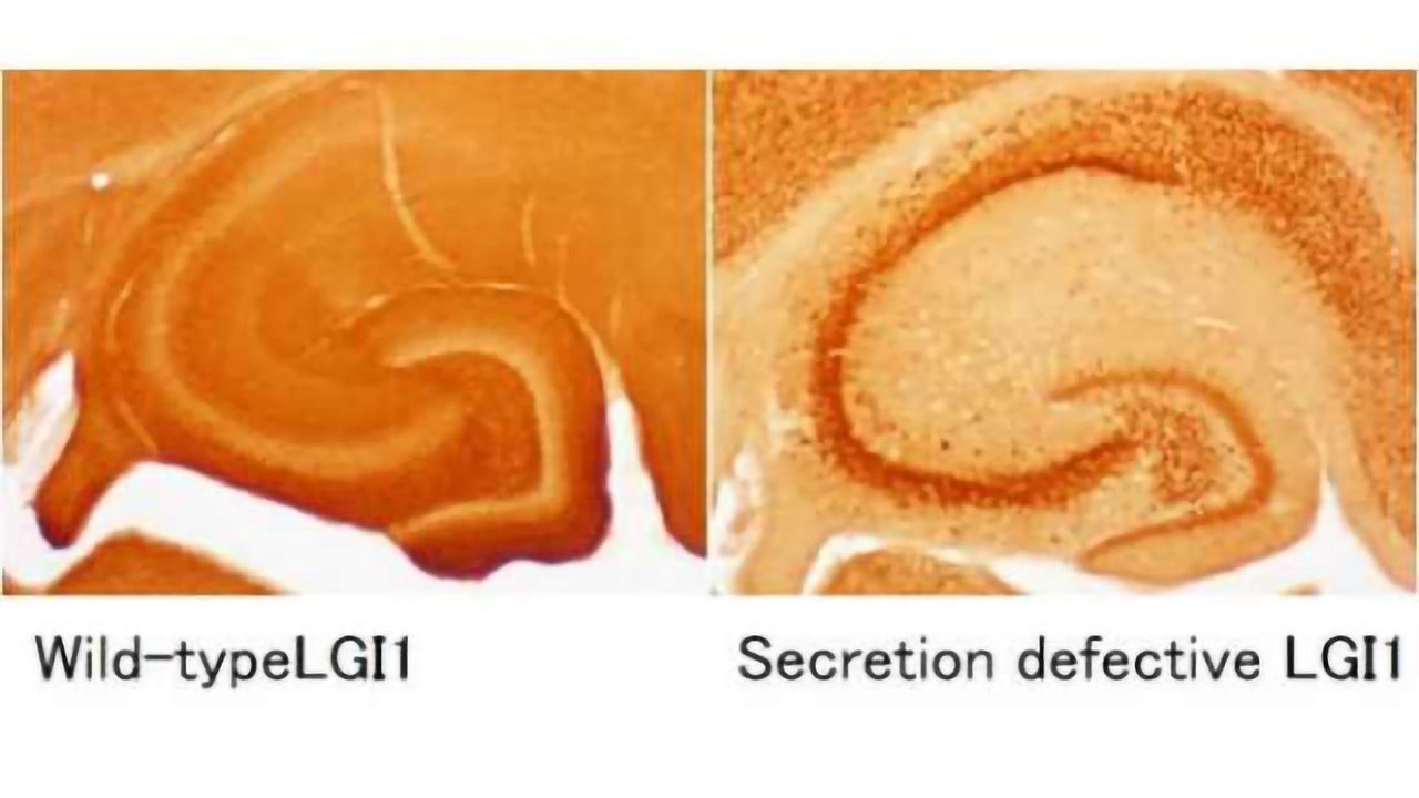 New treatment strategy for epilepsy