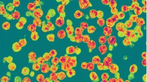 Hepatitis C ruled out as cause of mental impairment in HIV patients