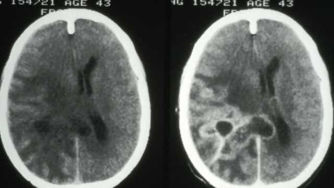 Important gene interaction that drives aggressive brain cancer defined