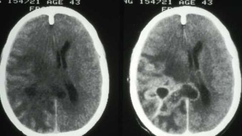 Important gene interaction that drives aggressive brain cancer defined