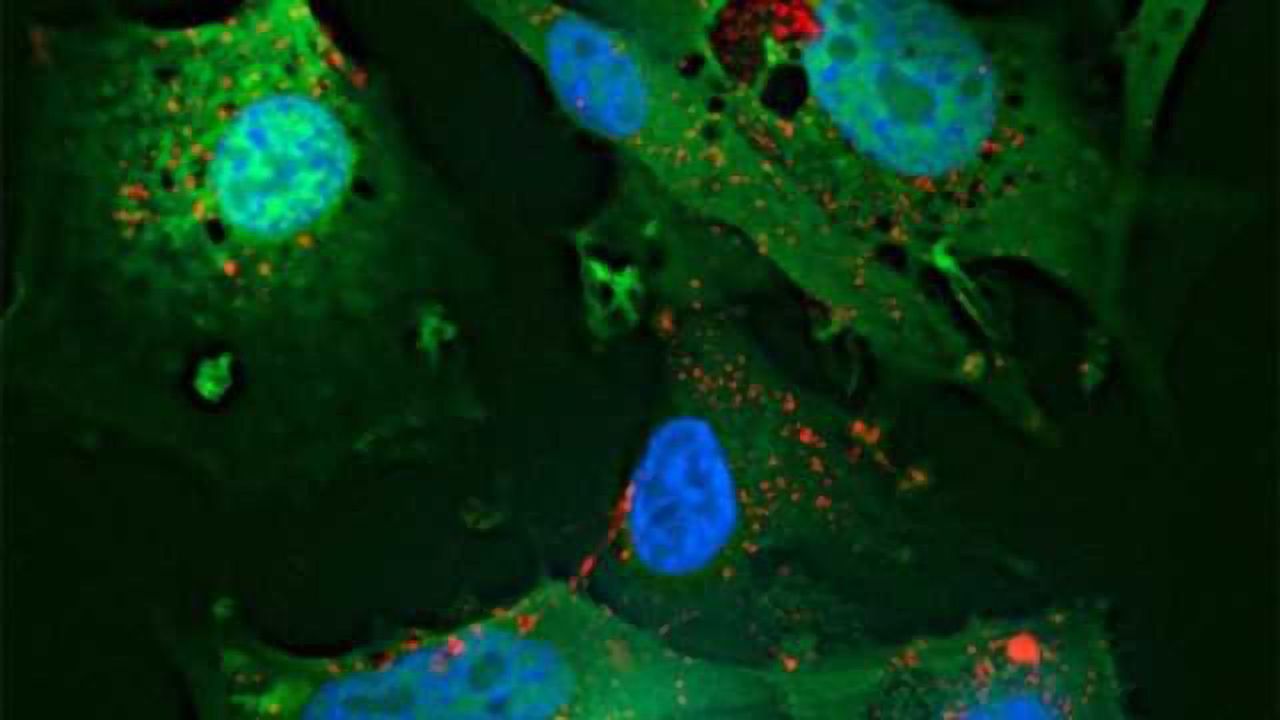 Signaling mechanism could be target for survival, growth of tumor cells in brain cancer