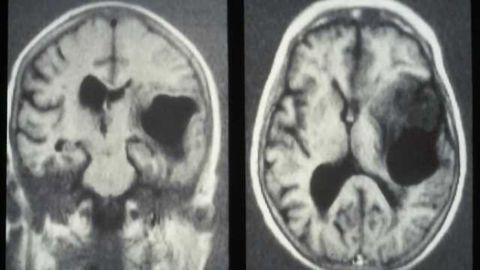 Orphan receptor proteins deliver 2 knock-out punches to glioblastoma cells