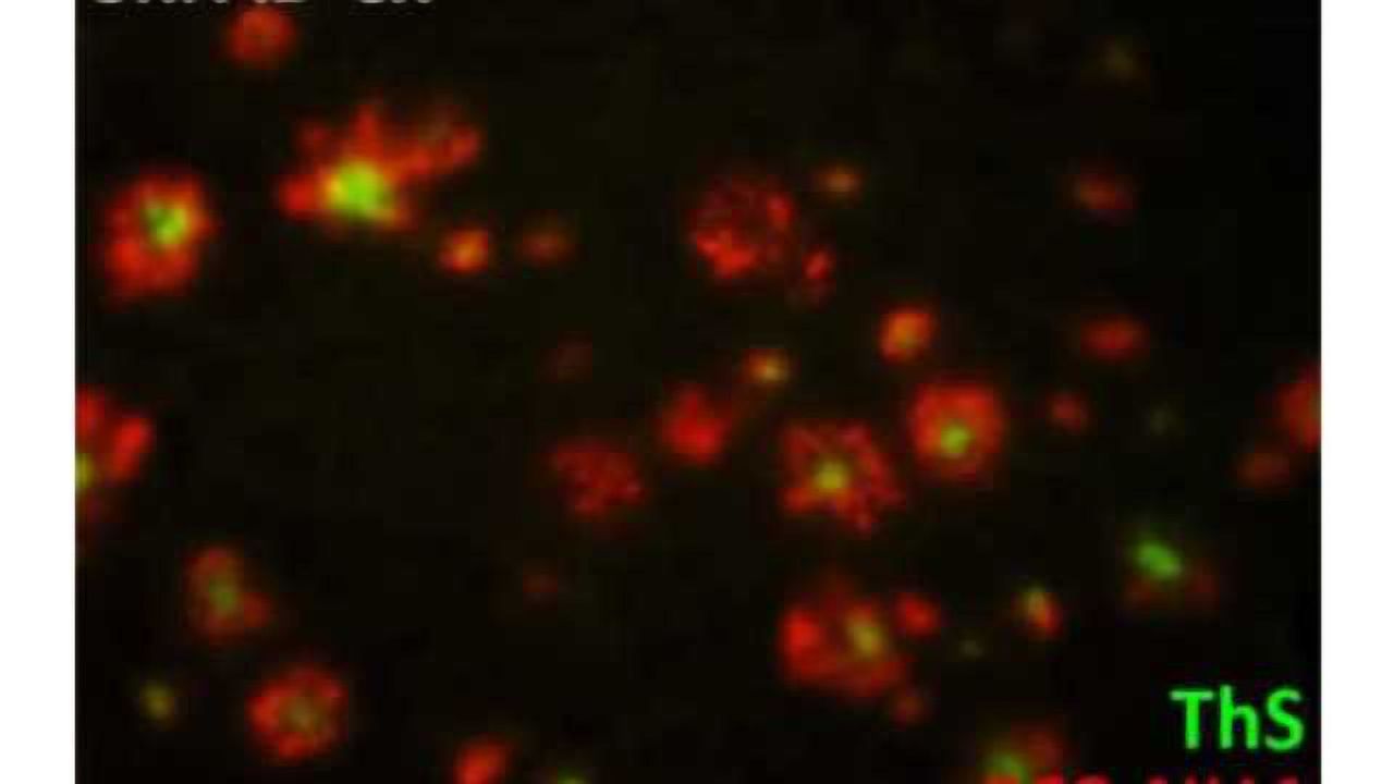 New non-invasive method can detect Alzheimer's disease early
