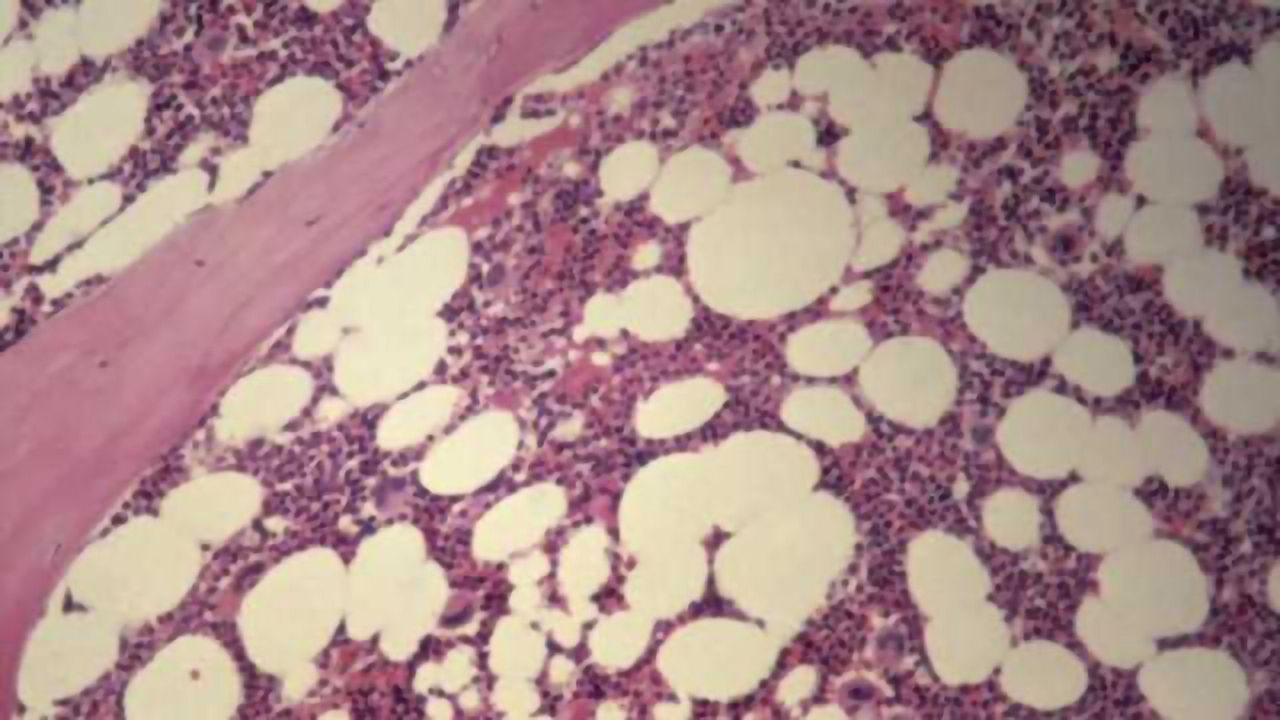 Report on Remission in Patients with MS Three Years After Stem Cell Transplant