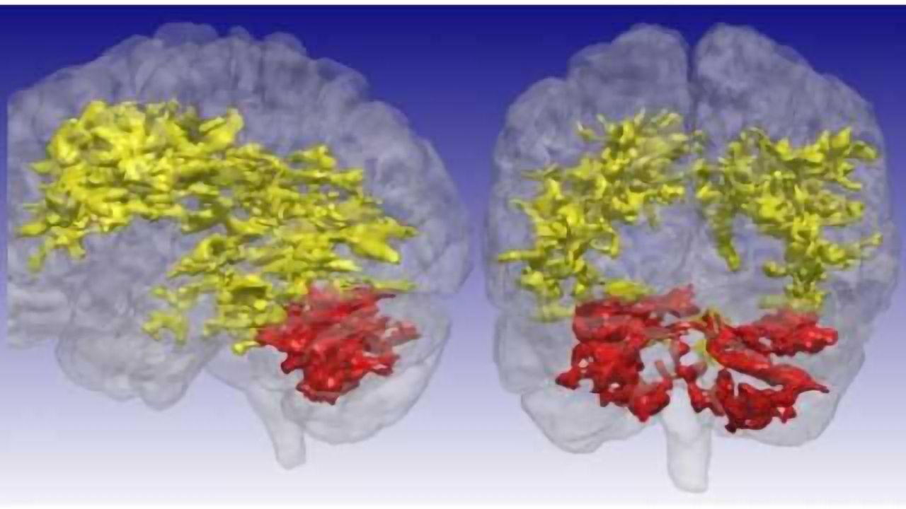 MRI scan sensitive to metabolic changes reveals brain differences in bipolar disorder