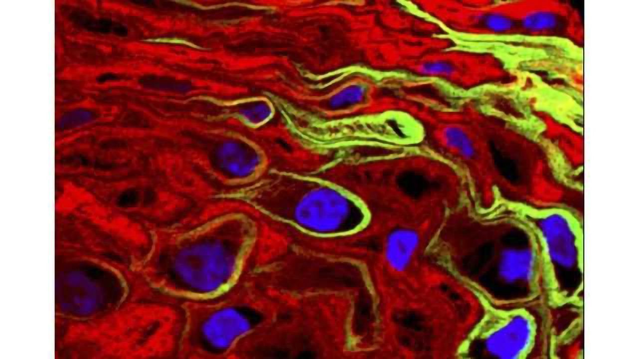 HPV vaccination not associated with increased risk of multiple sclerosis