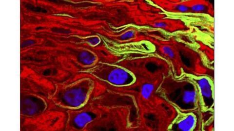 HPV vaccination not associated with increased risk of multiple sclerosis