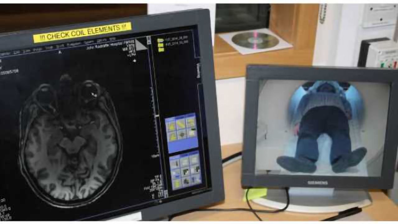 'Unfussy' brain finds ways of coping with loss of a hand