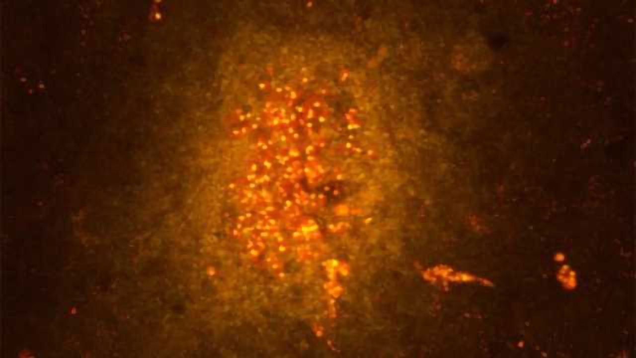 Development of psychosis: Gray matter loss and the inflamed brain