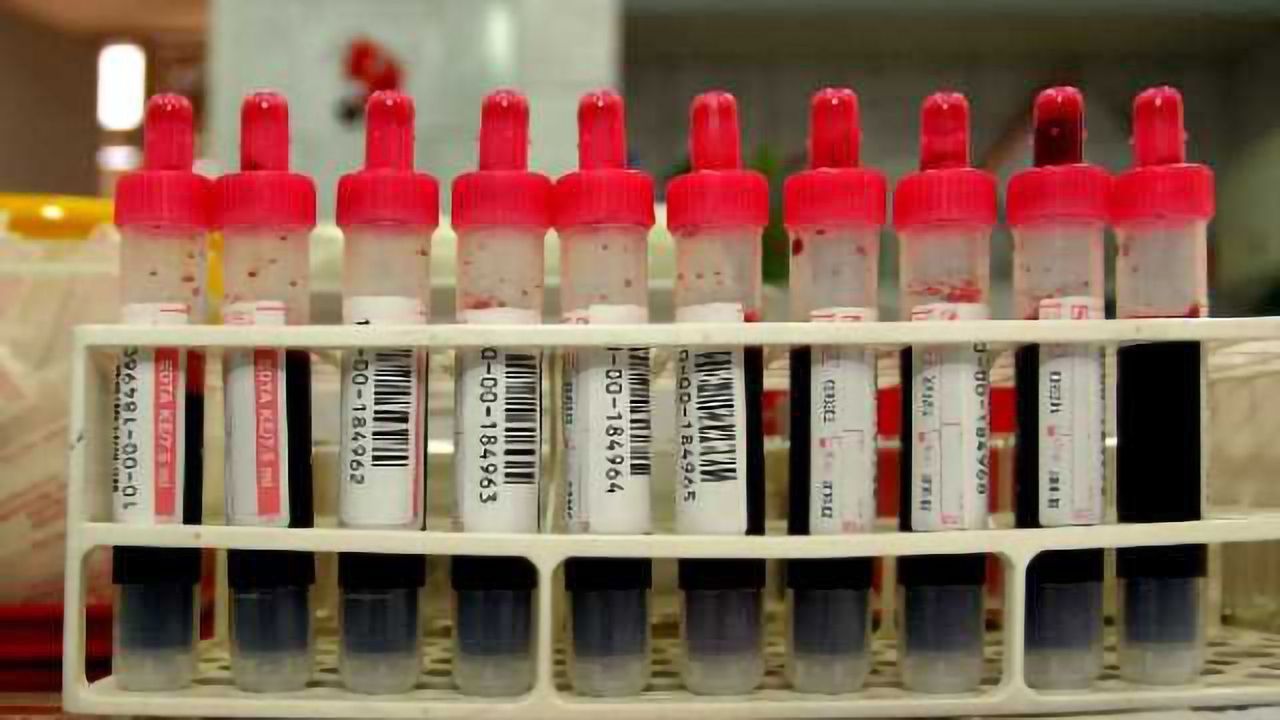 Blood Test for Brain Injury May Not Be Feasible