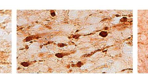 Combat veterans’ brains reveal hidden damage from IED blasts