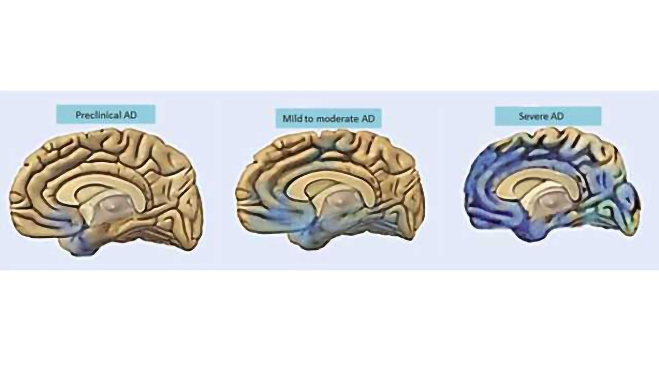Depression, behavioral changes may precede memory loss in Alzheimer’s