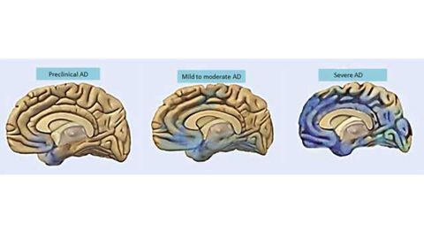 Depression, behavioral changes may precede memory loss in Alzheimer’s