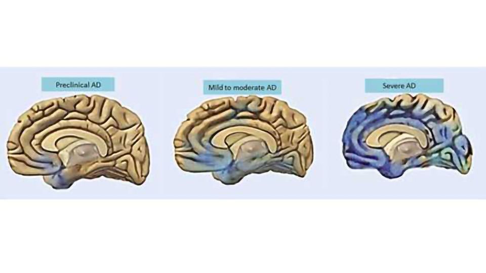 Depression, behavioral changes may precede memory loss in Alzheimer’s content piece image