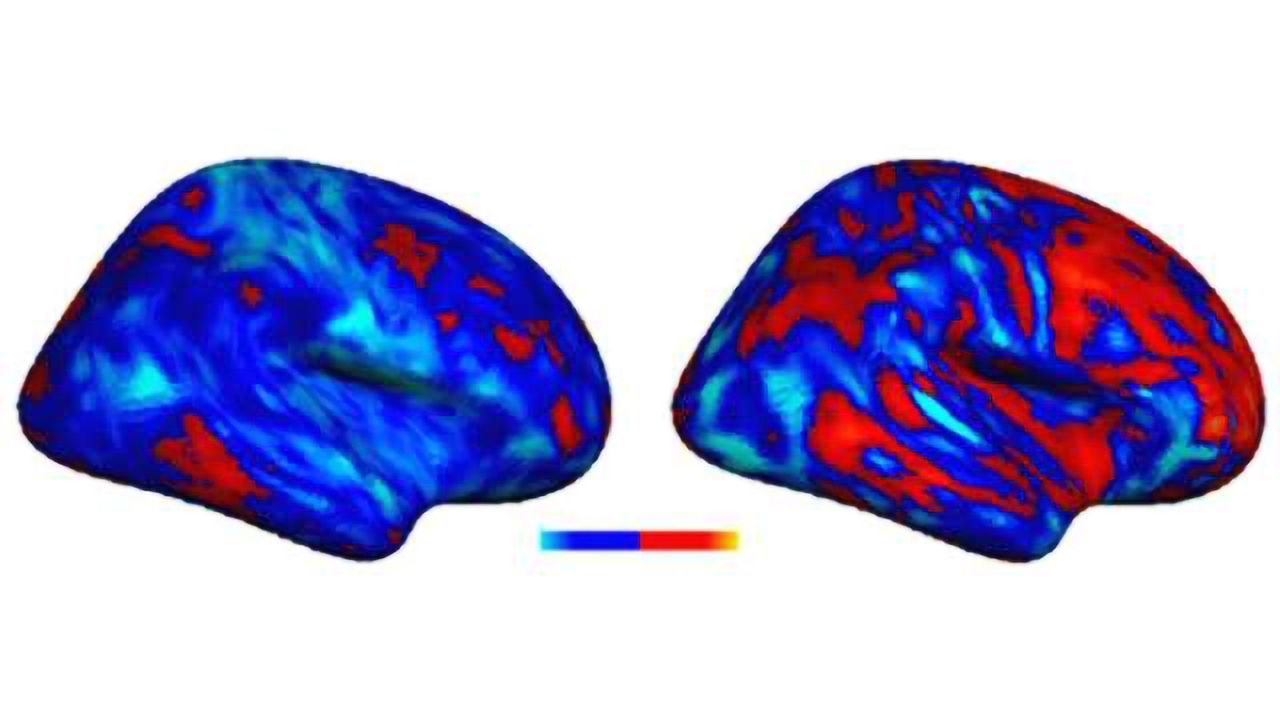 Researchers discover "idiosyncratic" brain patterns in autism