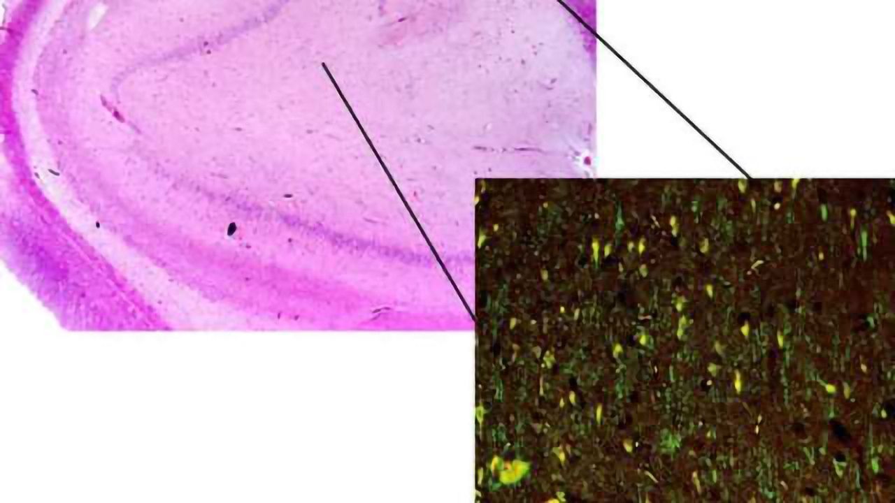 Dragnet for epilepsy genes