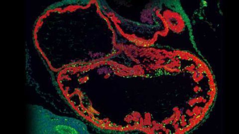Possible Therapeutic Target Revealed for Common, But Mysterious Brain Blood Vessel Disorder