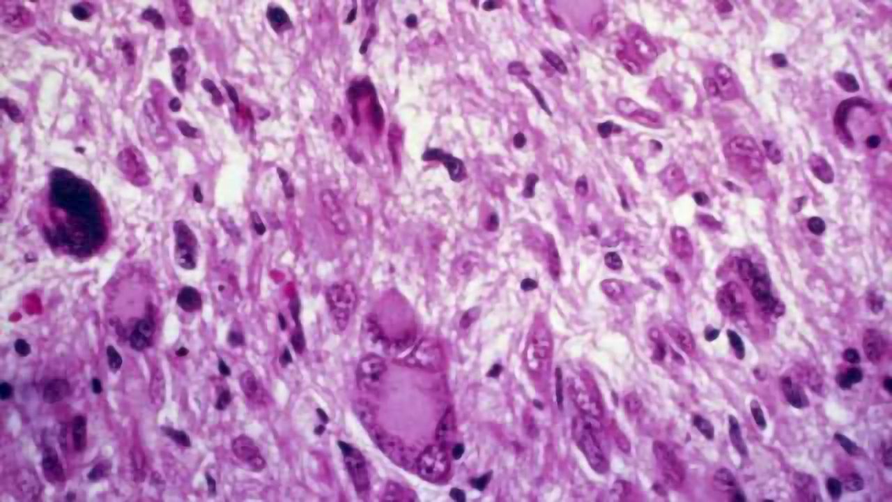New nanoparticle gene therapy strategy effectively treats deadly brain cancer in rats