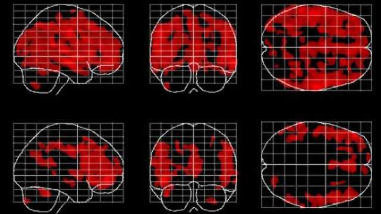 Forever young(er): Meditation might slow the age-related loss of gray matter in the brain