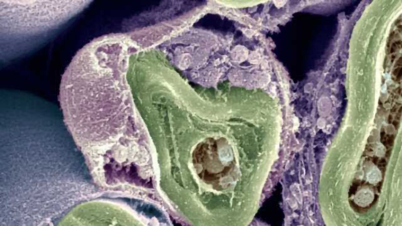 Pathological progression of multiple sclerosis documented for the first time