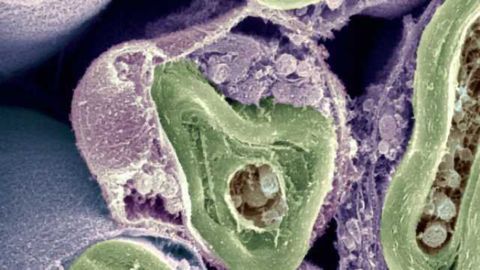 Pathological progression of multiple sclerosis documented for the first time